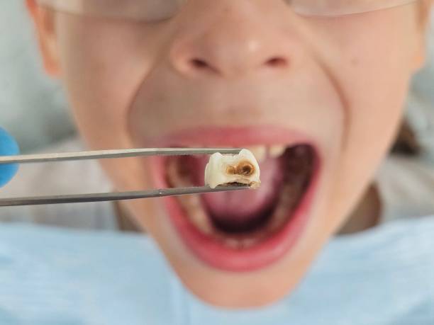 Best Root Canal Emergency Dentist  in Lexington, OK
