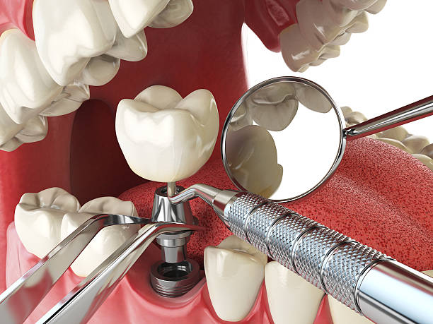 Best Knocked-Out Tooth Emergency  in Lexington, OK